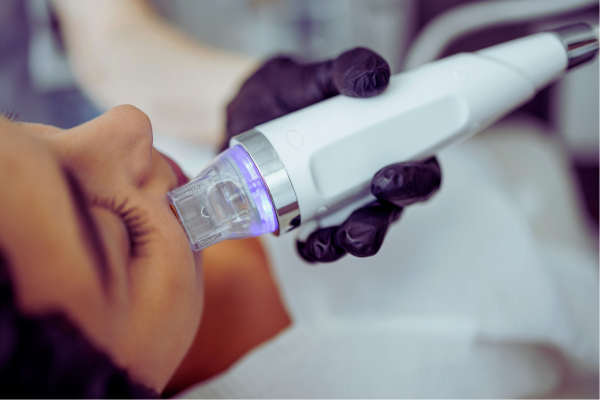 Microneedling treatment