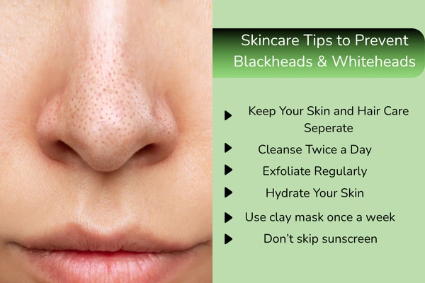 List of tips to prevent blackheads and whiteheads