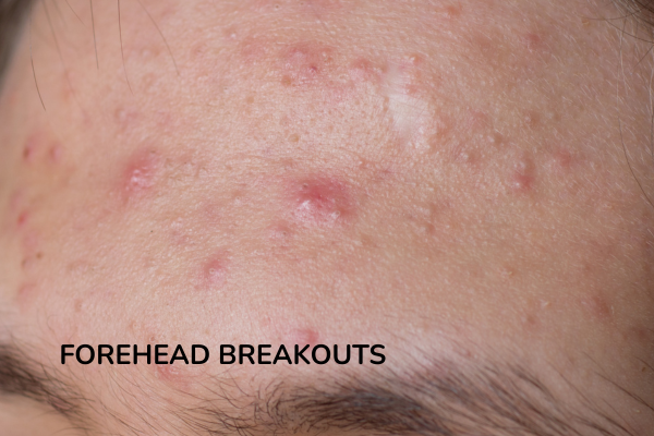 Forehead breakouts on women's face