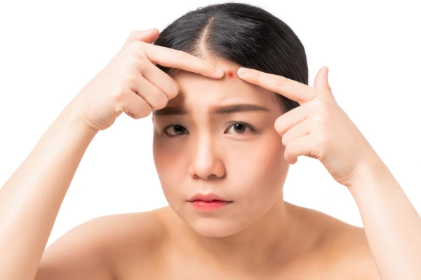 forehead pimples