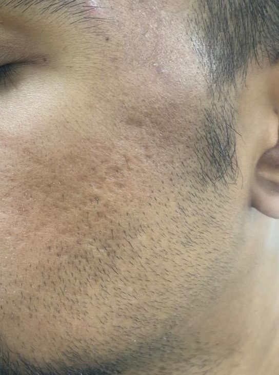 Radiant, even-textured skin with minimized pores and improved clarity after multiple treatment sessions of open pores treatment.