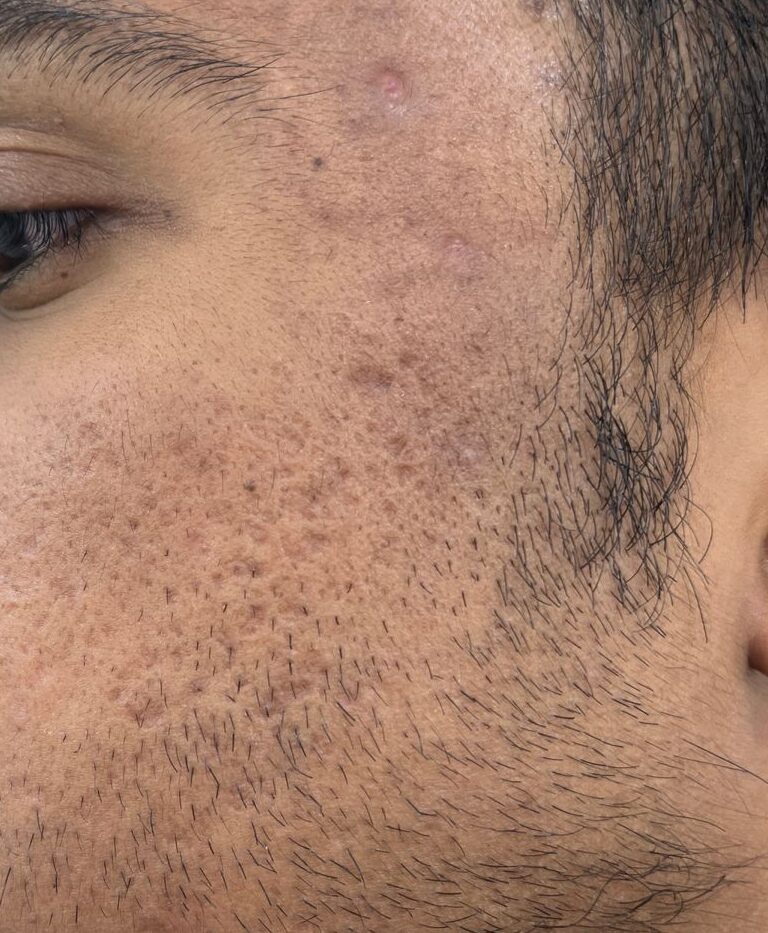A person skin with visibly open pores and dullness on face before treatment