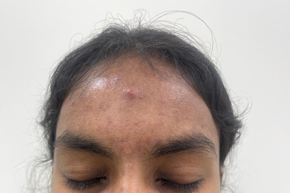 Forehead pimples treatment before and after images