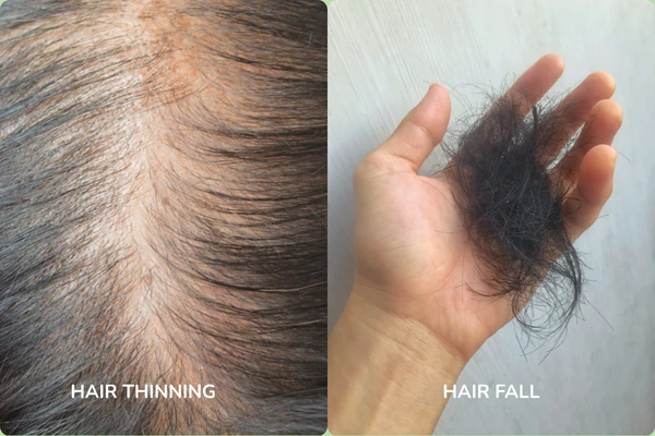 Hair thinning in men vs hair fall