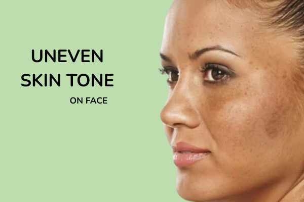 Uneven skin tone on face