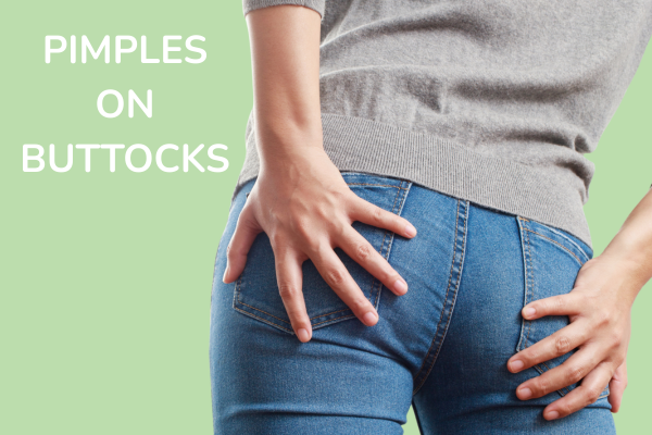 a women suffering with Pimples on buttocks