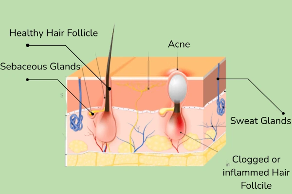 Image differentiating acne and hair follicle