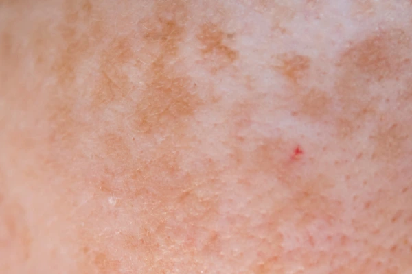 Hypopigmentation
