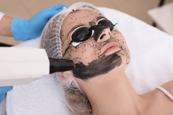 A women taking Carbon Laser Toning 