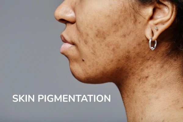 A women with skin pigmentation, such as acne marks and stubborn marks