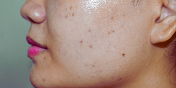 A women with dark spots on face