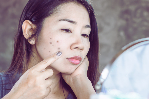 A women is worrying about her dark spots on face