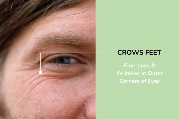 crows feet eyes
