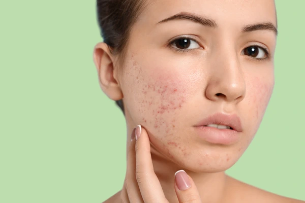 A women with acne holes on face