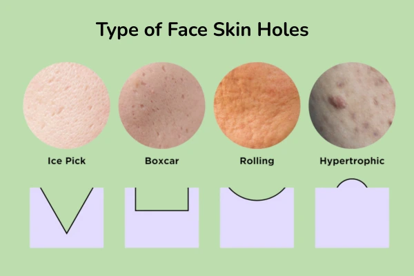 Types of face skin holes