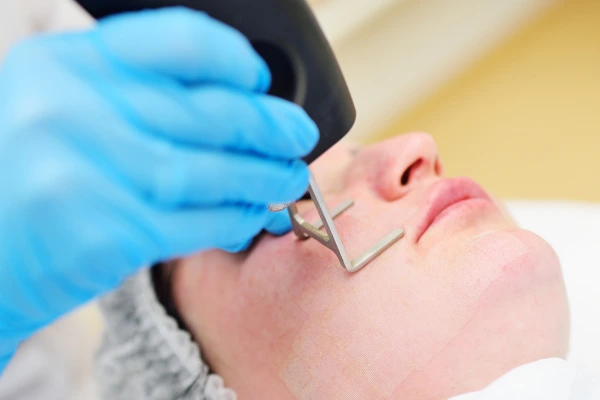Laser resurfacing (fractional CO2 laser)