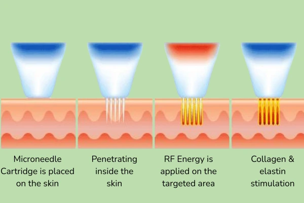 Scientific image how the microneedling with radiofrequency works