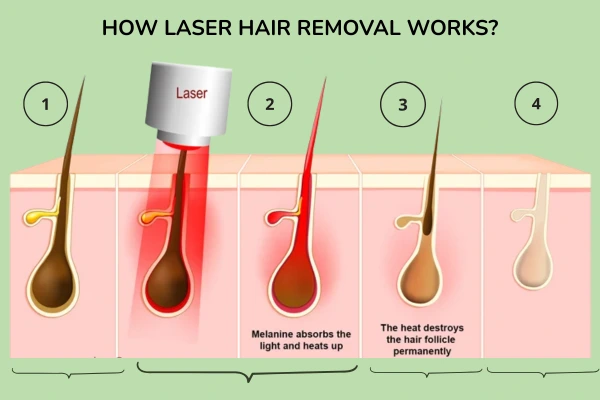 How laser hair removal treatment works