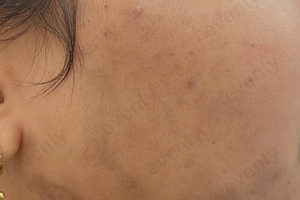 Pigmentation treatment before and after images