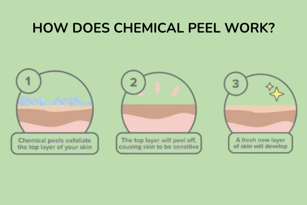 How does chemical peel works?