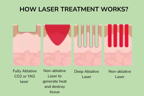 How laser treatment works?