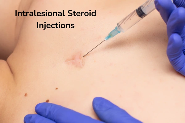 Intralesional steroid injections performed by dermatologists