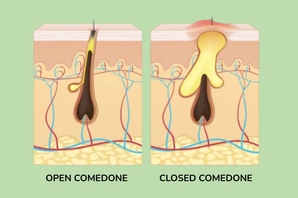Comedones - open and closed comedones