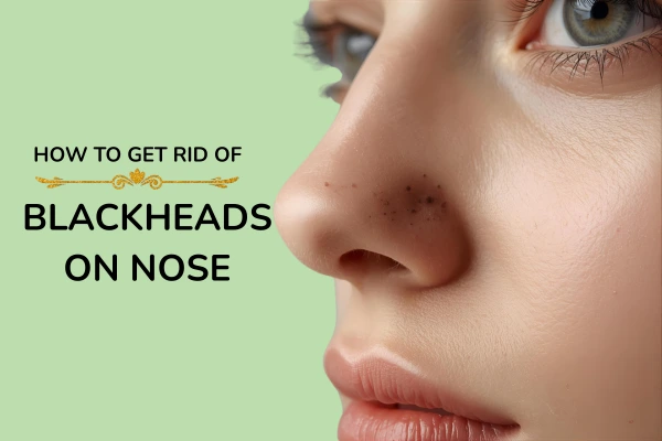 how to get rid of blackheads on nose