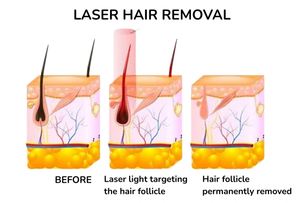 A diagram explaining how the laser hair removal works