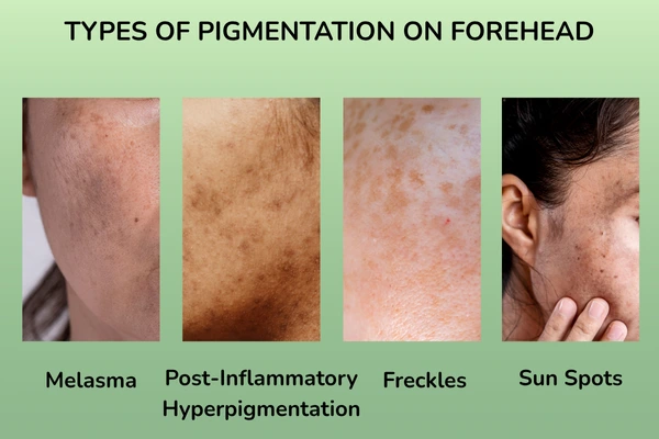 Types of pigmentation