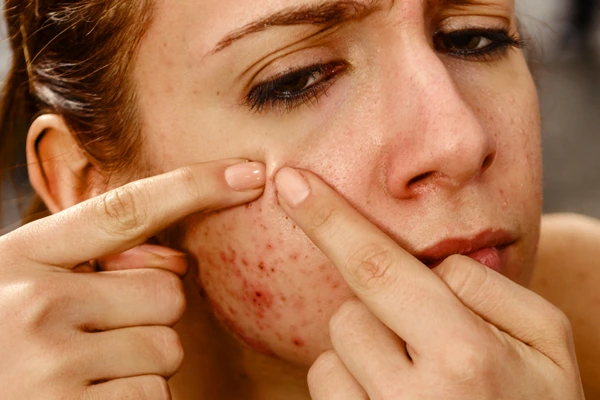 A young women pointing her spots caused by pimples