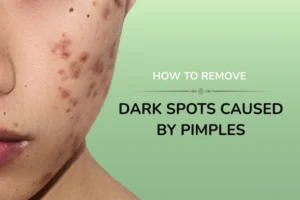 A women pointing her dark spots caused by pimples