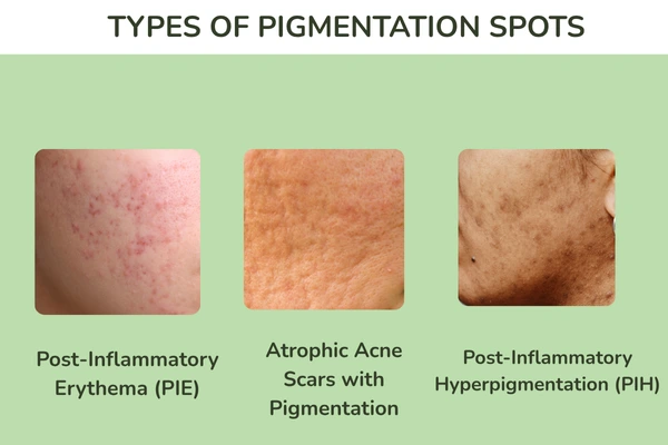 Types of pigmentation spots