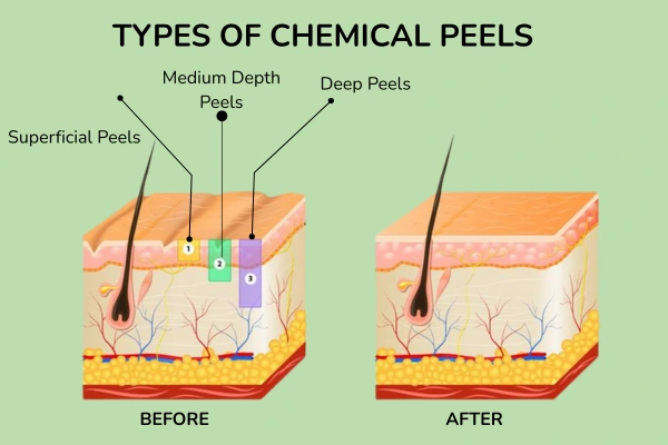 Types of Chemical Peels
