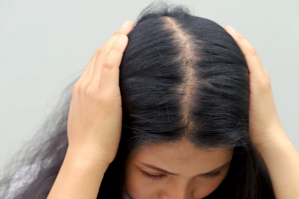 A women experiencing hair loss