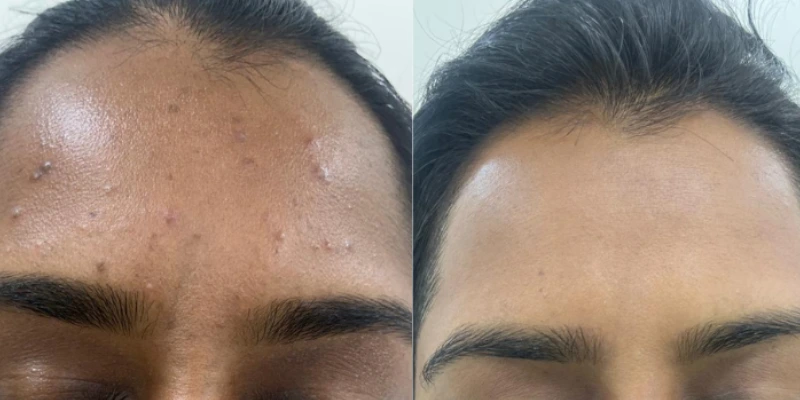 Before and after image of forehead pimples treatment