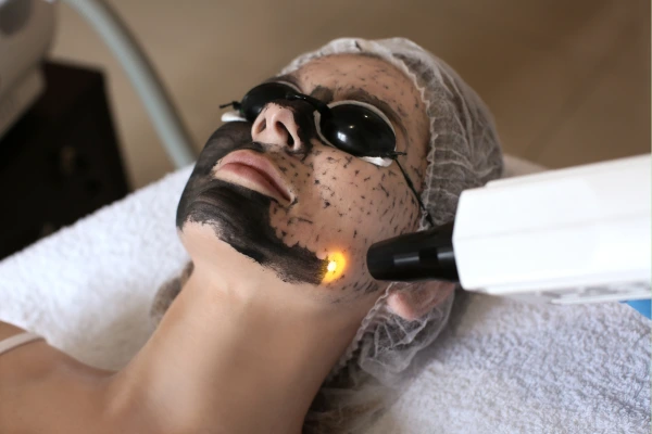 A young women taking carbon laser toning to get rid of bumps on face