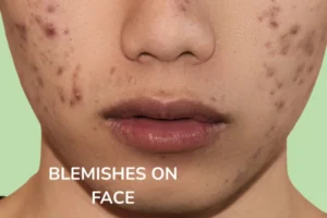A women with Blemishes on Face