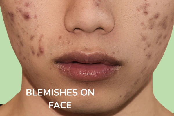 A women with Blemishes on Face