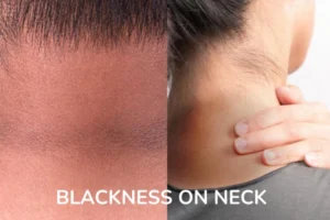 a WOMEN WITH BLACKNESS ON NECK