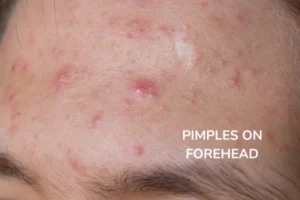 A women with pimples on forehead