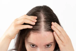 PCOS Hairloss
