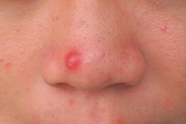 Pimples on nose