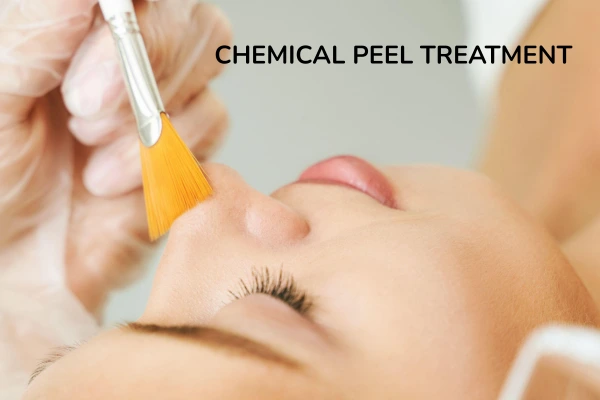 Chemical peel treatment