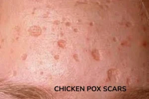 Chicken pox or varicella scars