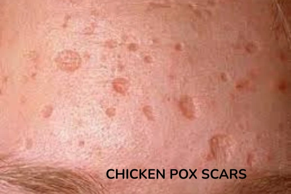 Chicken pox or varicella scars