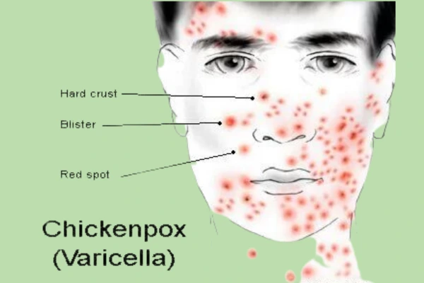 Chicken pox varicella scars