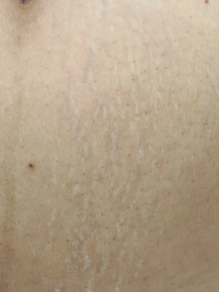 A women with stretch marks
