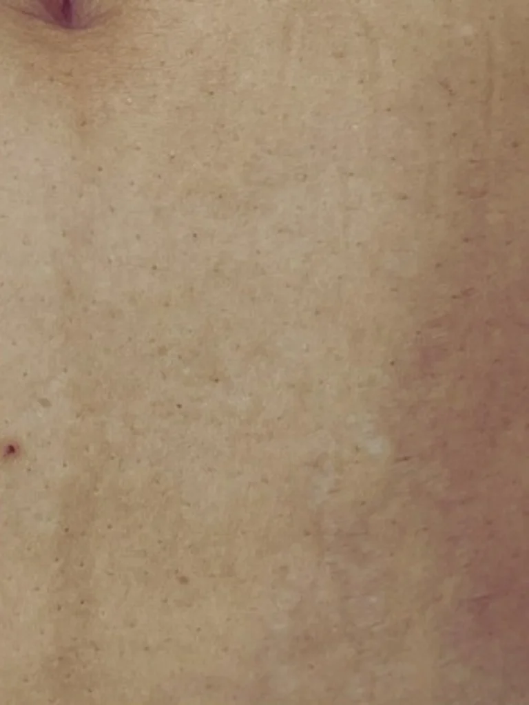 A women with smooth skin after stretch marks treatment