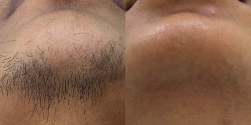 before and after image of facial laser hair removal